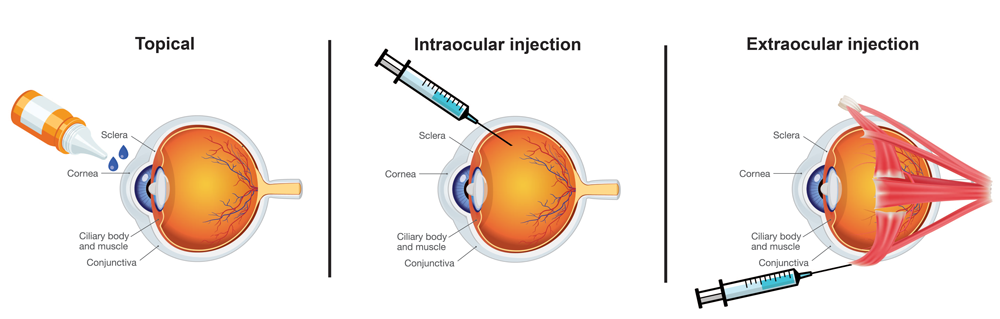 ciliary injection